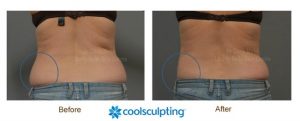 CoolSculpting Before And After